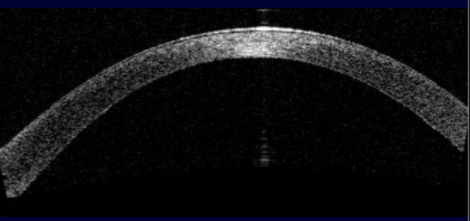 DMEK anterior segment OCT