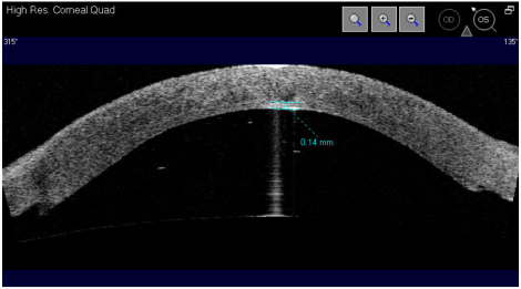 DSAEK anterior segment OCT
